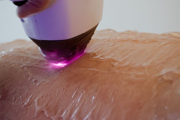 Buz Lazer (Diode) Nedir? Neden Tercih Edilir?